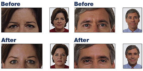 BOTOX clinic in Bridgeport WV Before and After Images