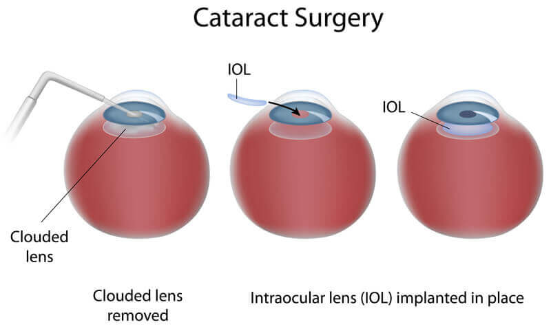 Cataract surgery in Bridgeport, WV Chart Showing the Cataract Surgery Process