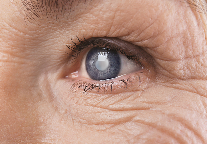 Closeup of a Cataract in an Eye