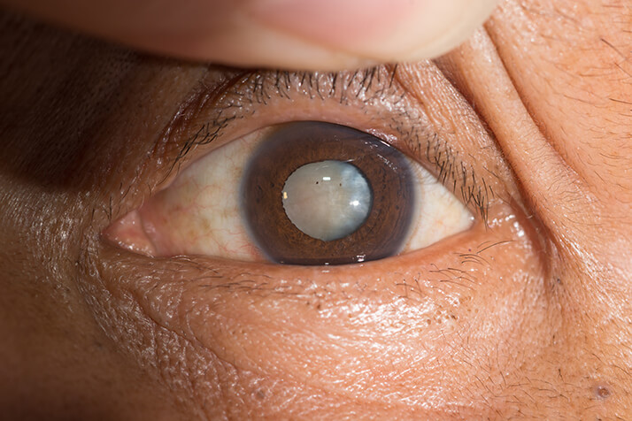 Closeup of a Cataract