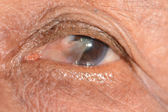 Closeup of Pterygium