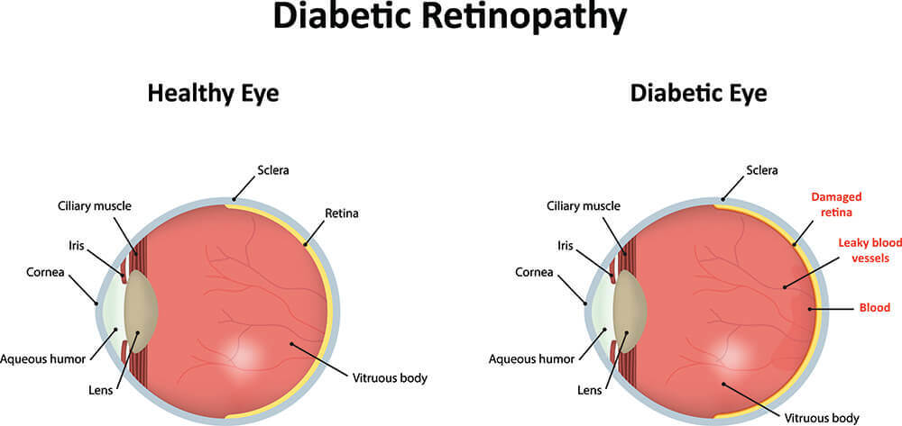 Chart Showing a Healthy Eye Compared to One That Has Diabetic Retinopathy