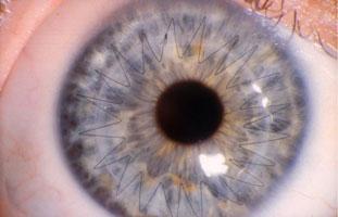 Closeup of an Eye That's Had a Corneal Transplant