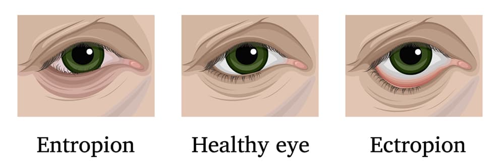 Diagram of a Healthy Eye Compared to one with Entropion and One With Ectropion