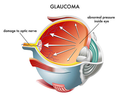 Chart Showing How Glaucoma Affects the Eye from our glaucoma specialist in Bridgeport, WV