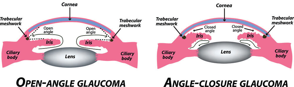 Chart Showing How Open-Angle Glaucoma and Angle-Closure Glaucoma Affect the Eye