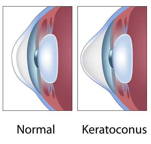 Chart Illustrating a Normal Eye Compared to One With Keratoconus