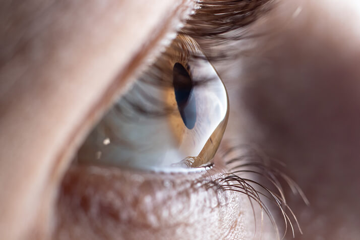 Closeup of an Eye With Karatoconus