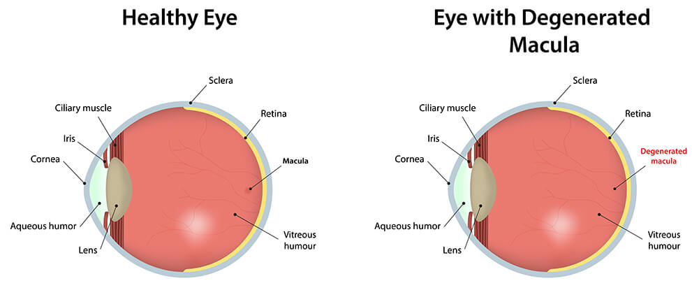 Chart Showing a Healthy Eye Compared to one with a Degenerated Macula