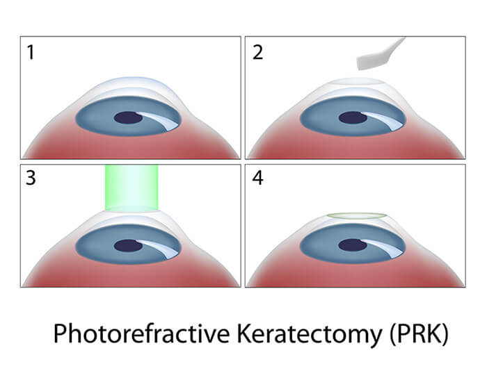 Blocks numbered 1-4 of animated eyes showing alternatives to lasik and refractive eye sugery.