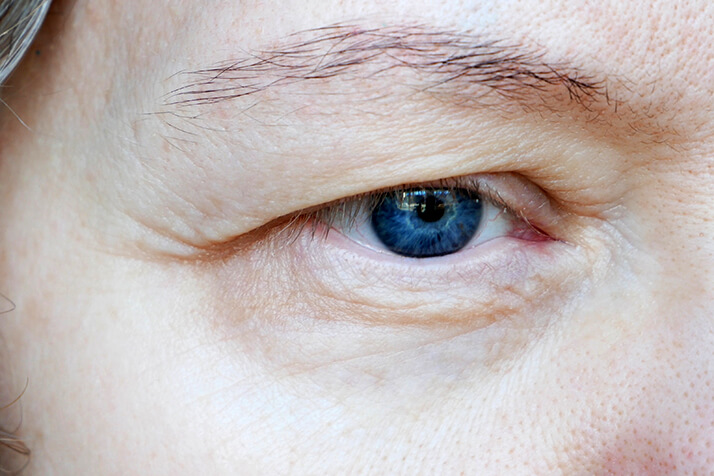 Closeup of an Eye Experiencing Ptosis