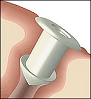 Punctal Plug Insertion